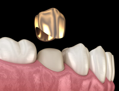 gold crown, dental crown procedure