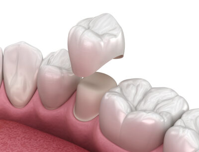 dental crowns