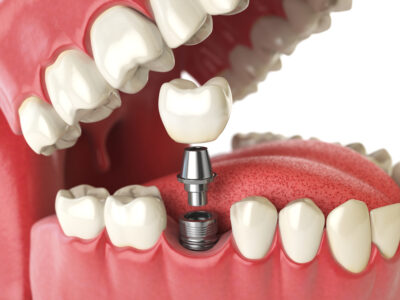 dental implant procedure