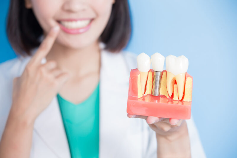 full mouth dental implants