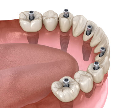 full mouth dental implants