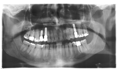 dental implant xrays