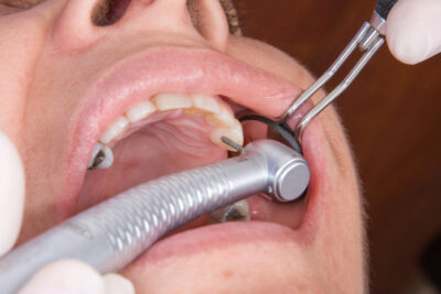 dental bridge procedure, dental bridges for missing teeth