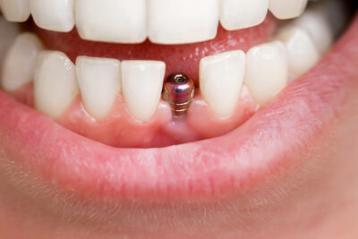 dental implant, dental implants 