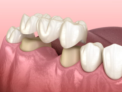 dental bridges, dental bridge 