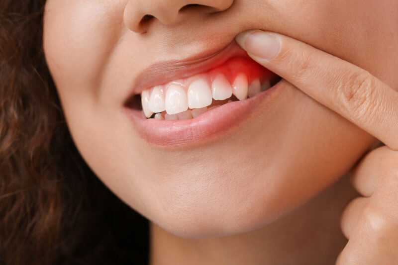 a woman with inflamed gums possibly periodontal disease