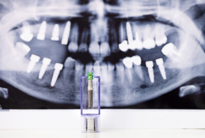 dental implants, dental implant x-ray 