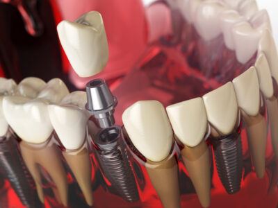 dental implant, dental implants, tooth implant