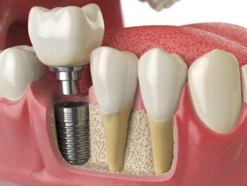 how healthy teeth and a dental implant are placed 