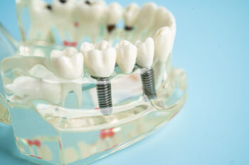 artificial tooth showing how dental implants are placed into the jaw 
