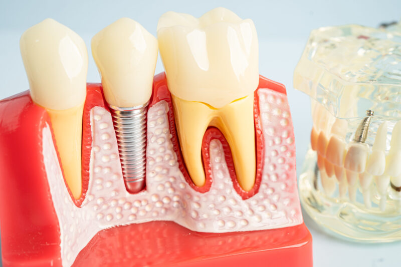 model of teeth showing single dental implant