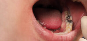 damaged and rotten teeth that need dental restorations