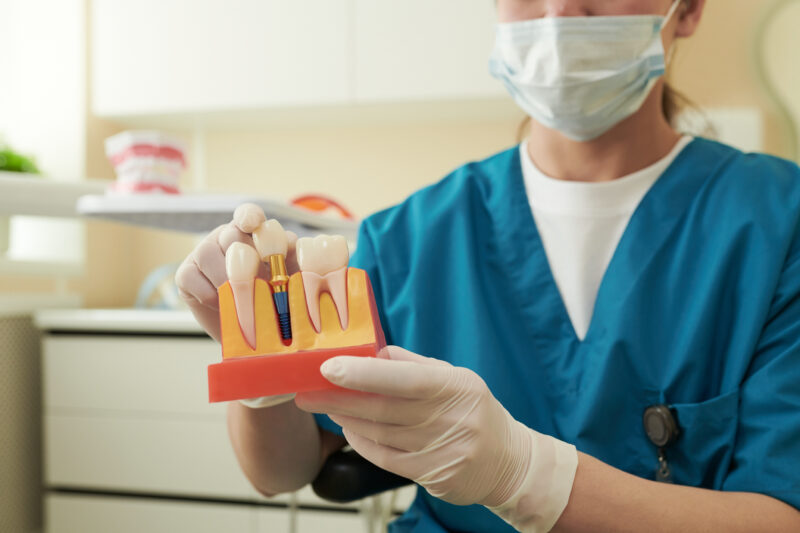 dentist holding dental implant model - showing what before and after dental implants will look like